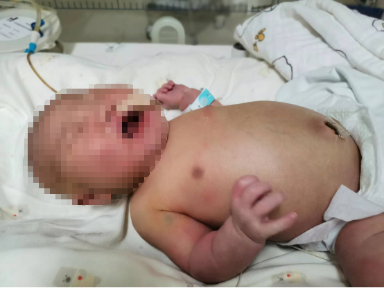 出生2天的新生儿上手术台，医生“轻易不下手 下手定有数”